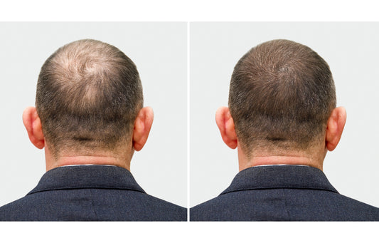 Hair Transplantation: Procedures and Considerations