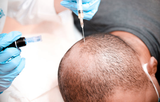 Platelet-rich plasma (PRP) Treatment for Hair Loss