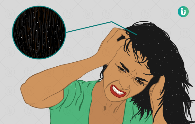Decoding Dandruff: Causes, Treatments, and Effective Management