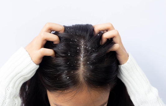 The Connection Between Dandruff and Hair Loss